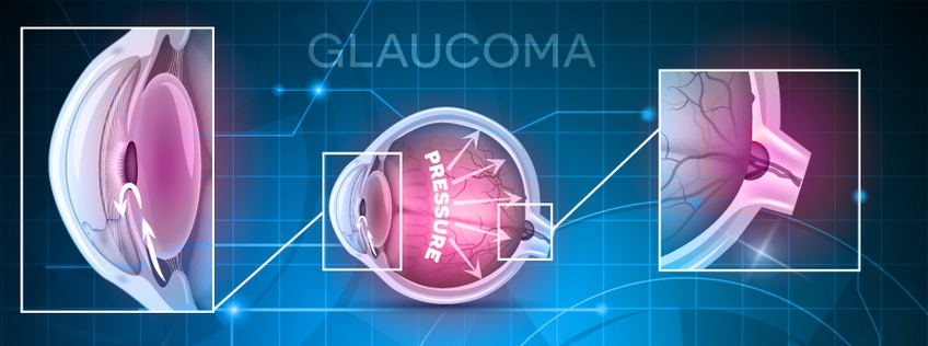 Glaucoma: The Essentials
