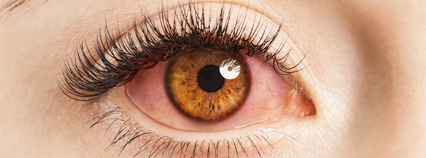 Red eyes: What to do and when to see a doctor 